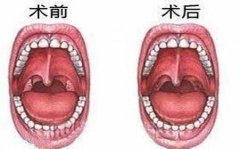 成都小孩扁桃体肥大引起打呼噜怎么办