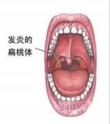 慢性扁桃体炎,到底该不该割啦?