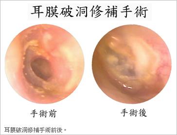 鼓膜穿孔的三大危害是什么