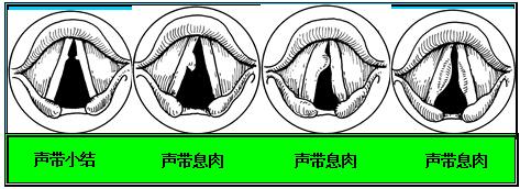 成都治疗声带小结医院