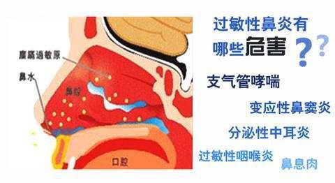 成都经常打喷嚏是怎么回事