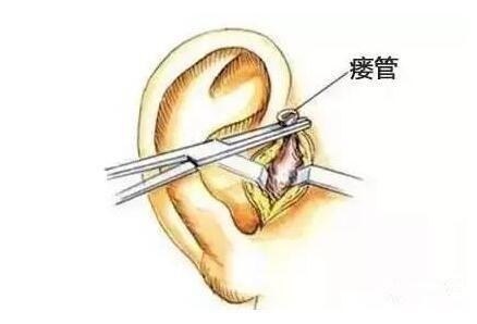 成都哪家医院可以治耳前瘘管