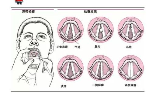 成都小孩子患了声带小结怎么办