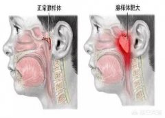 腺样体肥大该如何治疗?