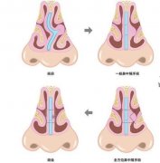 成都鼻中隔偏曲的主要症状是什么?