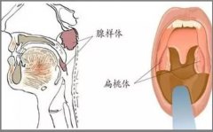 腺样体肥大早期有哪些症状?