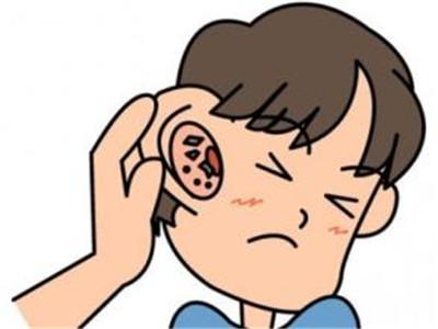 成都外耳道炎的危害有多大?