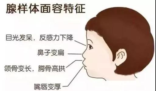 成都仁品治疗腺样体肥大怎么样?