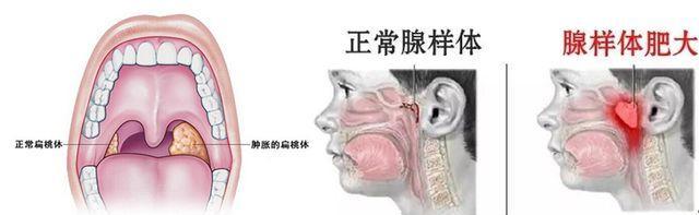 导致出现腺样体肥大的原因有哪些?