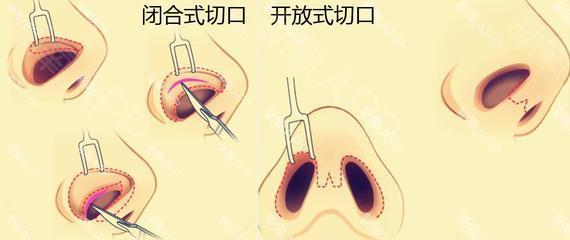 成都鼻中隔偏曲的病因是什么