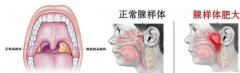 小孩做腺样体肥大手术哪家医院好?